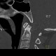 Osteoplastic metastasis of prostate cancer: CT - Computed tomography