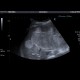 Liver hemangioma, huge: US - Ultrasound