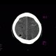 Occipital conus, brain edema, subarachnoid hemorrhage, pneumocephalus: CT - Computed tomography