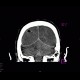 Occipital conus, brain edema, subarachnoid hemorrhage, pneumocephalus: CT - Computed tomography
