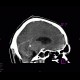 Occipital conus, brain edema, subarachnoid hemorrhage, pneumocephalus: CT - Computed tomography
