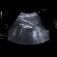 Kindey stones, casting stones, nephrolithiasis: US - Ultrasound