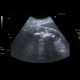 Kindey stones, casting stones, nephrolithiasis: US - Ultrasound