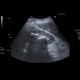 Kindey stones, casting stones, nephrolithiasis: US - Ultrasound