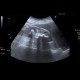 Kindey stones, casting stones, nephrolithiasis: US - Ultrasound