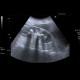 Kindey stones, casting stones, nephrolithiasis: US - Ultrasound