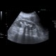 Kindey stones, casting stones, nephrolithiasis: US - Ultrasound