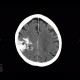 Oligodendroglioma of parietal lobe: CT - Computed tomography