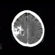 Oligodendroglioma of parietal lobe: CT - Computed tomography