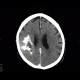 Oligodendroglioma of parietal lobe: CT - Computed tomography