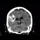 Oligodendroglioma of parietal lobe: CT - Computed tomography