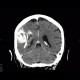 Oligodendroglioma of parietal lobe: CT - Computed tomography