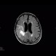 Oligodendroglioma of parietal lobe: MRI - Magnetic Resonance Imaging