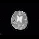 Oligodendroglioma of parietal lobe: MRI - Magnetic Resonance Imaging