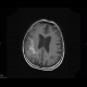 Oligodendroglioma of parietal lobe: MRI - Magnetic Resonance Imaging