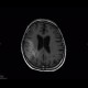 Oligodendroglioma of parietal lobe: MRI - Magnetic Resonance Imaging