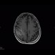 Oligodendroglioma of parietal lobe: MRI - Magnetic Resonance Imaging