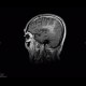 Oligodendroglioma of parietal lobe: MRI - Magnetic Resonance Imaging