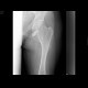 Ollier's disease, enchondromatosis: X-ray - Plain radiograph