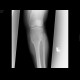 Ollier's disease, enchondromatosis: X-ray - Plain radiograph