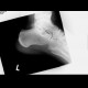 Os trigonum: X-ray - Plain radiograph