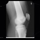 Osgood-Schlatter, aseptic necrosis of tibial tuberosity: X-ray - Plain radiograph