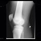 Osgood-Schlatter, aseptic necrosis of tibial tuberosity: X-ray - Plain radiograph