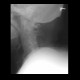 Osseous block of cervical vertebra: X-ray - Plain radiograph