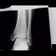 Osteoid osteoma: X-ray - Plain radiograph