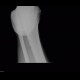 Osteoid osteoma: X-ray - Plain radiograph