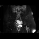 Osteoid osteoma: MRI - Magnetic Resonance Imaging