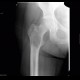 Osteolytic changes of femur: X-ray - Plain radiograph