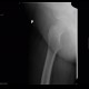 Osteolytic changes of femur: X-ray - Plain radiograph