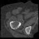 Osteolytic changes of femur: CT - Computed tomography