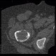 Osteolytic changes of femur: CT - Computed tomography