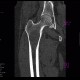 Osteolytic changes of femur: CT - Computed tomography