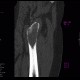 Osteolytic changes of femur: CT - Computed tomography