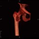 Osteolytic changes of femur: CT - Computed tomography