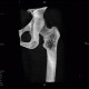 Osteolytic changes of femur: CT - Computed tomography