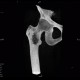 Osteolytic changes of femur: CT - Computed tomography