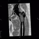 Osteolytic changes of femur: CT - Computed tomography