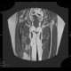 Osteolytic changes of femur: MRI - Magnetic Resonance Imaging