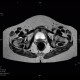 Osteolytic changes of femur: MRI - Magnetic Resonance Imaging