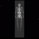 Osteolytic changes of femur: NM - Nuclear medicine