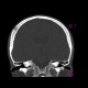 Osteolytic metastasis of renal cell carcinoma in skull: CT - Computed tomography