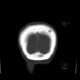 Osteolytic metastasis of renal cell carcinoma in skull: CT - Computed tomography