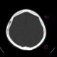 Osteolytic metastasis of renal cell carcinoma in skull: CT - Computed tomography