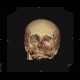 Osteolytic changes of facial skeleton: CT - Computed tomography