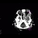 Osteolytic changes of facial skeleton: CT - Computed tomography