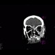 Osteolytic changes of facial skeleton: CT - Computed tomography
